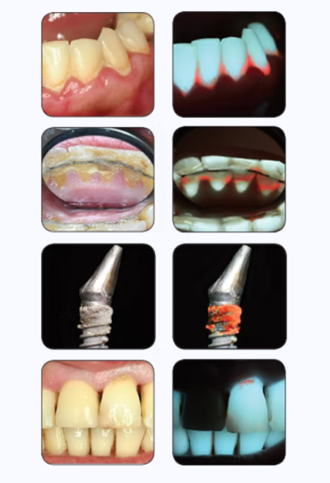REVEAL® Visiomedical Lupenbrille mit Fluoreszenz-Technologie